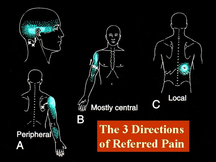 The 3 Directions of Referred Pain 