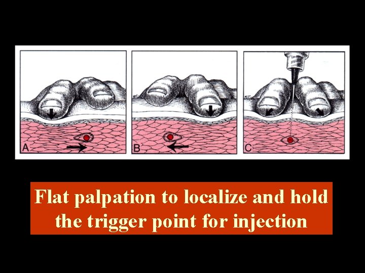 Flat palpation to localize and hold the trigger point for injection 