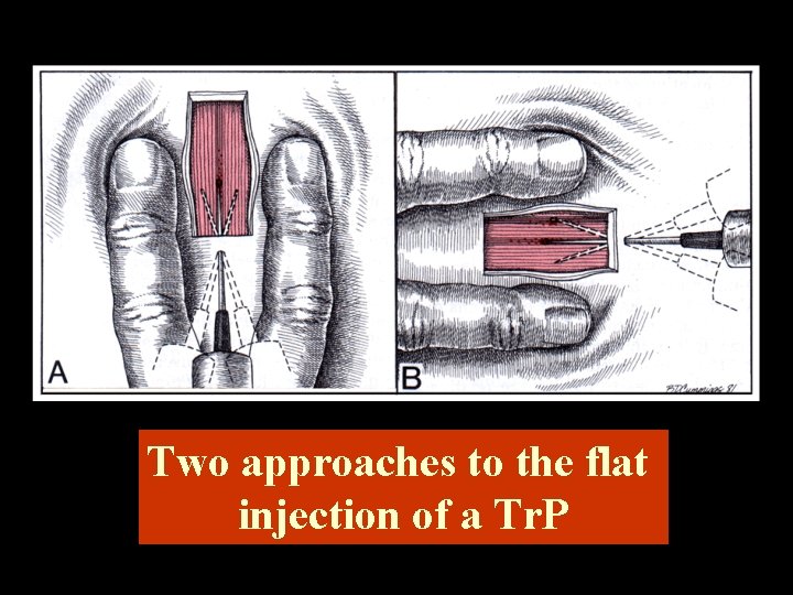 Two approaches to the flat injection of a Tr. P 