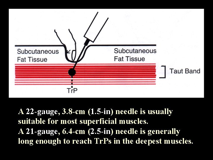 A 22 -gauge, 3. 8 -cm (1. 5 -in) needle is usually suitable for