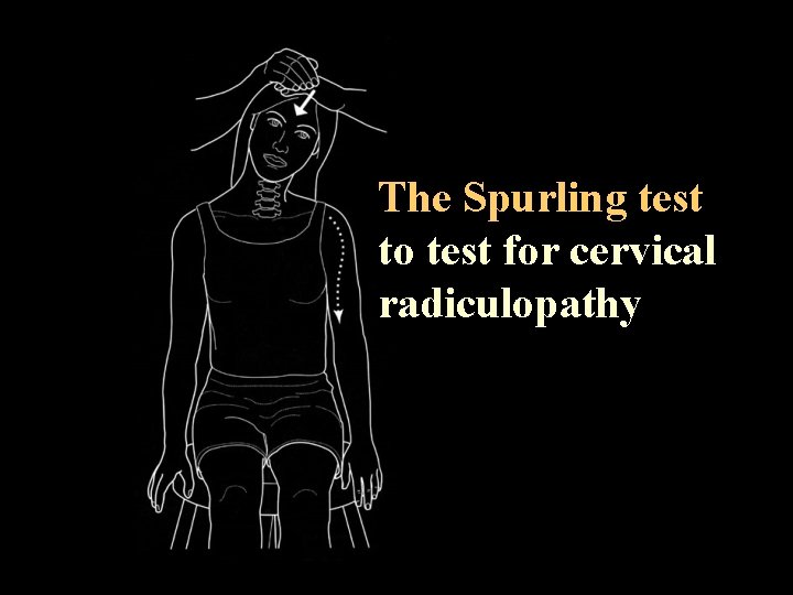 The Spurling test to test for cervical radiculopathy 