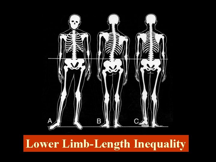 Lower Limb-Length Inequality 