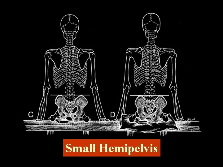Small Hemipelvis 