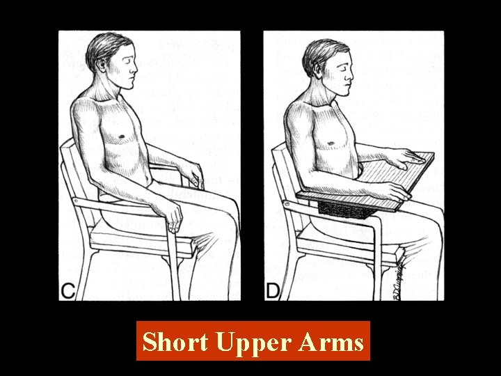 Short Upper Arms 