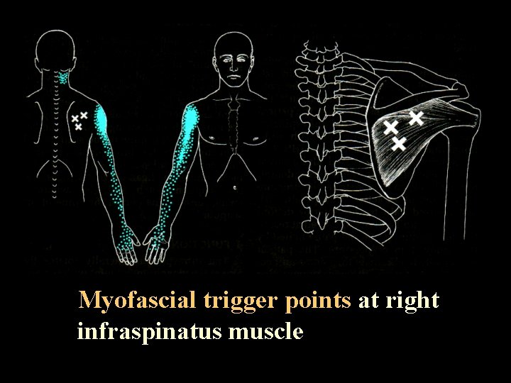 Myofascial trigger points at right infraspinatus muscle 