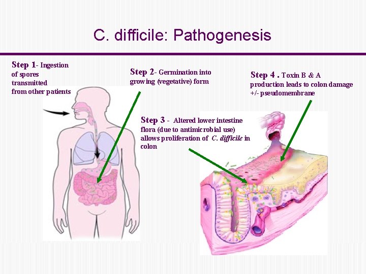 C. difficile: Pathogenesis Step 1 - Ingestion of spores transmitted from other patients Step