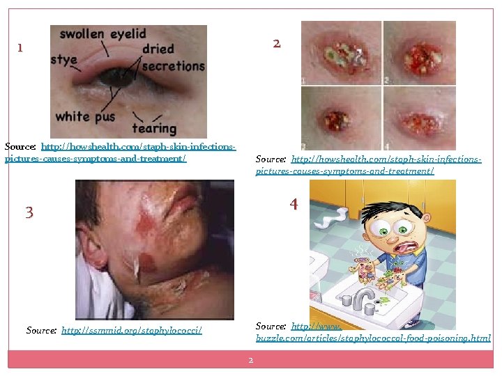 2 1 Source: http: //howshealth. com/staph-skin-infectionspictures-causes-symptoms-and-treatment/ 4 3 Source: http: //www. buzzle. com/articles/staphylococcal-food-poisoning. html