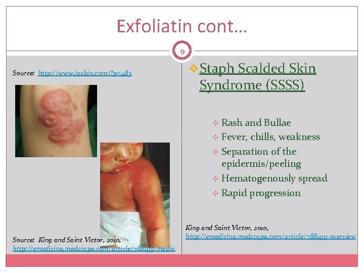 Exfoliatin cont… 9 Source: http: //www. jaskin. com/? p=485 v. Staph Scalded Skin Syndrome