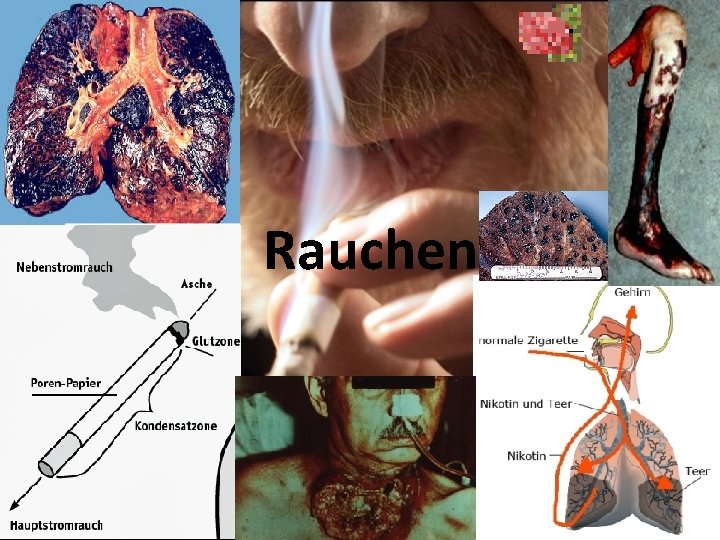 Rauchen 