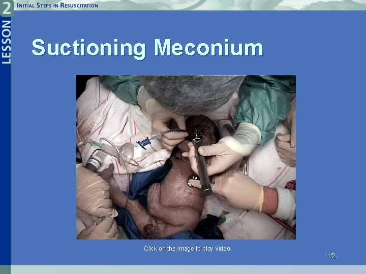 Suctioning Meconium Click on the image to play video 12 
