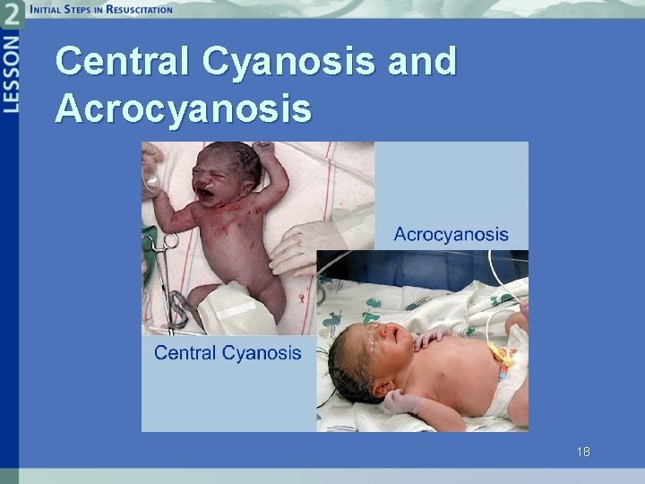Central Cyanosis and Acrocyanosis 18 