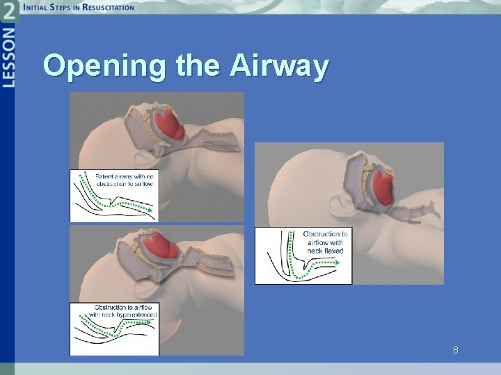 Opening the Airway 8 