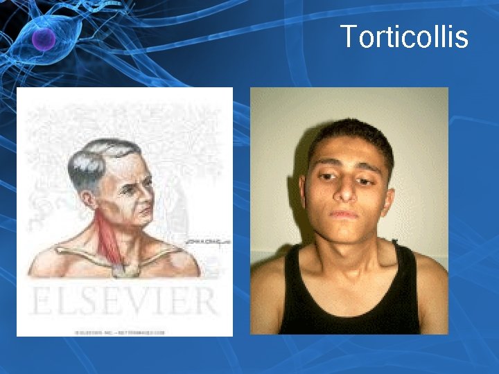 Torticollis 