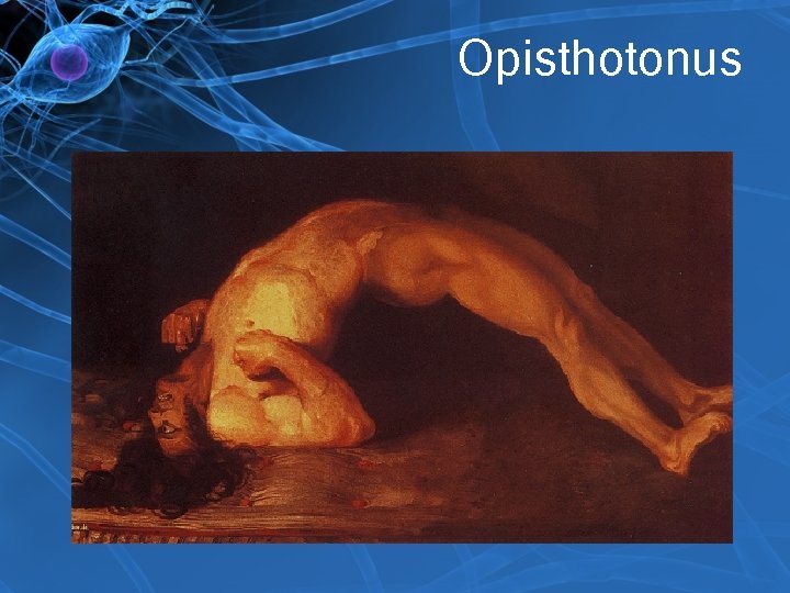 Opisthotonus 