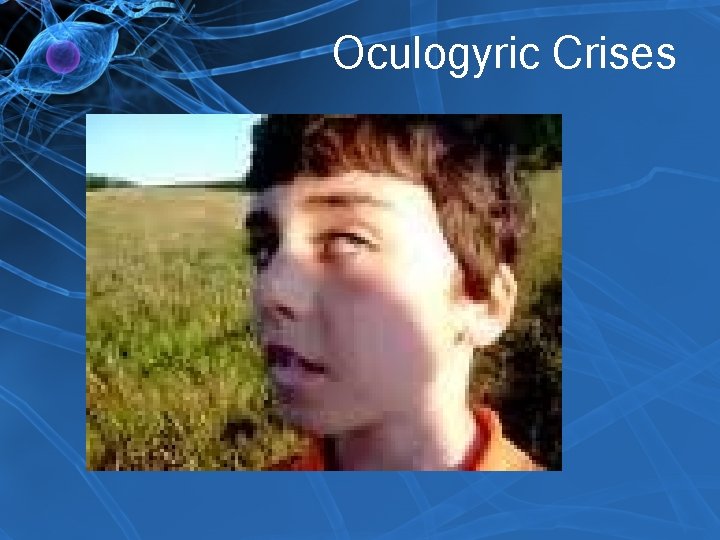 Oculogyric Crises 