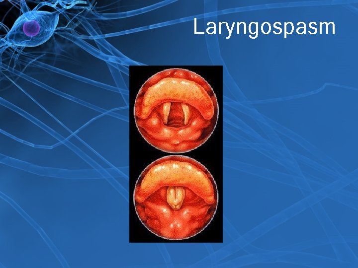 Laryngospasm 