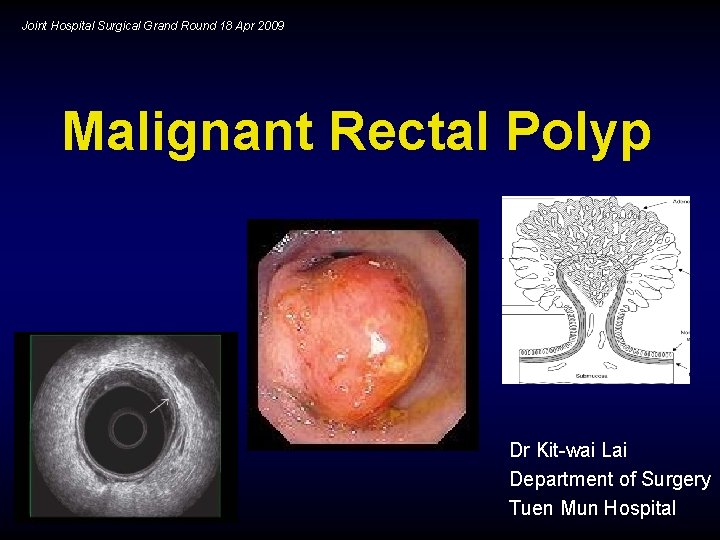 Joint Hospital Surgical Grand Round 18 Apr 2009 Malignant Rectal Polyp Dr Kit-wai Lai