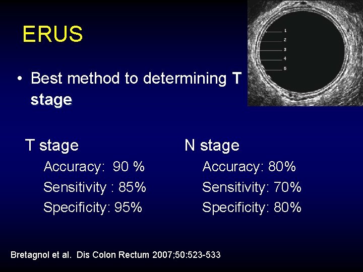 ERUS • Best method to determining T stage Accuracy: 90 % Sensitivity : 85%