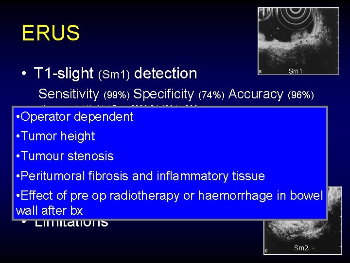 ERUS • T 1 -slight (Sm 1) detection Sm 1 Sensitivity (99%) Specificity (74%)