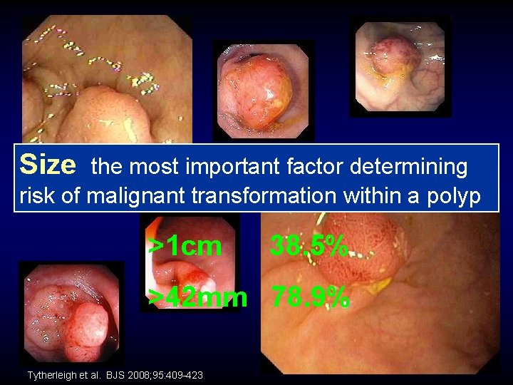 Size Malignant? the most important factor determining risk of malignant transformation within a polyp