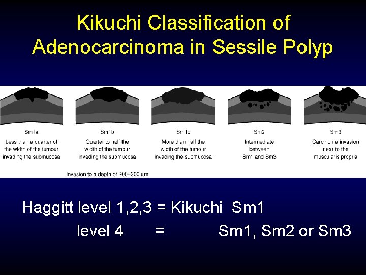 Kikuchi Classification of Adenocarcinoma in Sessile Polyp Haggitt level 1, 2, 3 = Kikuchi