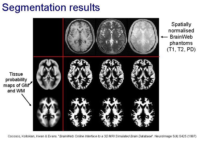 Segmentation results Spatially normalised Brain. Web phantoms (T 1, T 2, PD) Tissue probability