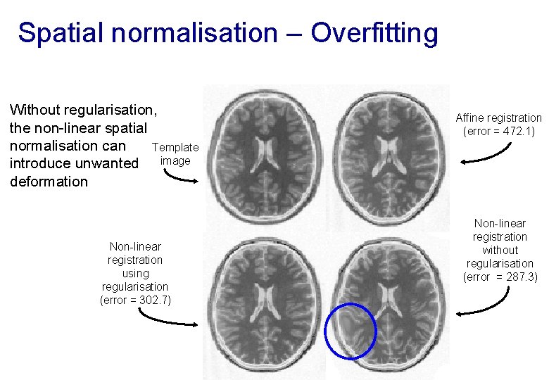 Spatial normalisation – Overfitting Without regularisation, the non-linear spatial normalisation can Template introduce unwanted