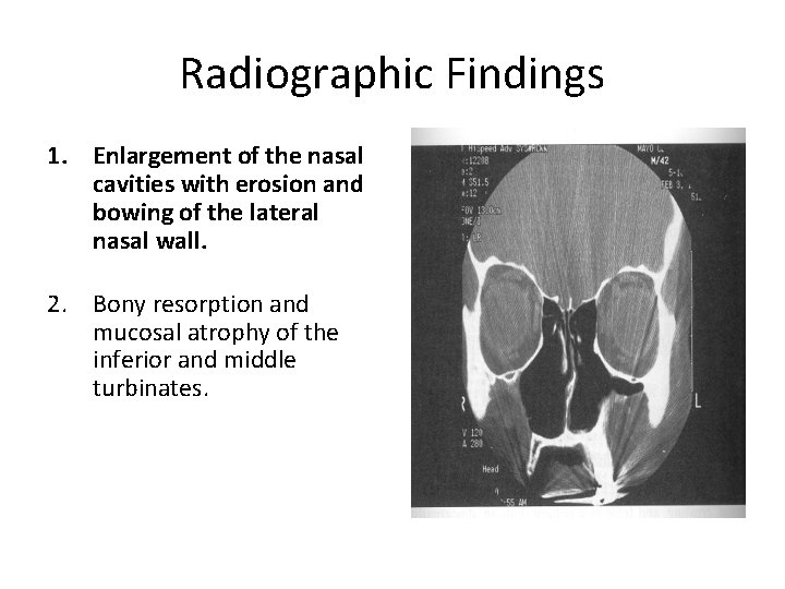 Radiographic Findings 1. Enlargement of the nasal cavities with erosion and bowing of the