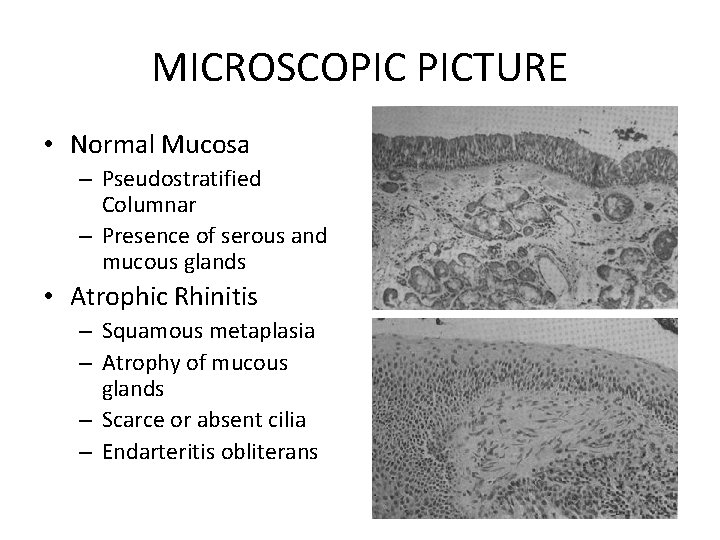 MICROSCOPIC PICTURE • Normal Mucosa – Pseudostratified Columnar – Presence of serous and mucous
