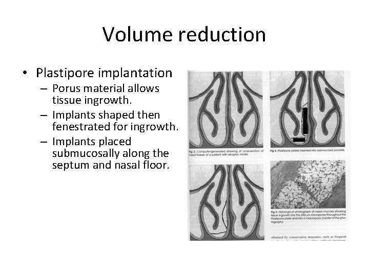 Volume reduction • Plastipore implantation – Porus material allows tissue ingrowth. – Implants shaped