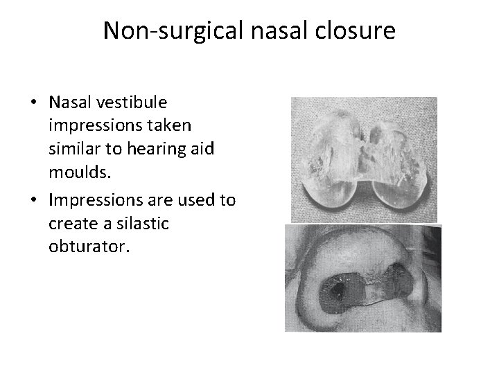 Non-surgical nasal closure • Nasal vestibule impressions taken similar to hearing aid moulds. •