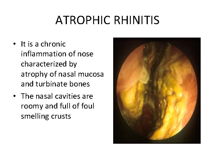 ATROPHIC RHINITIS • It is a chronic inflammation of nose characterized by atrophy of