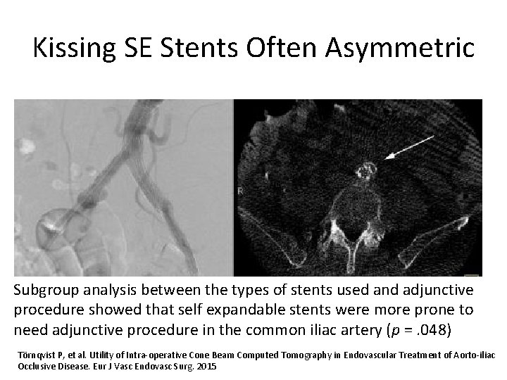 Kissing SE Stents Often Asymmetric Subgroup analysis between the types of stents used and