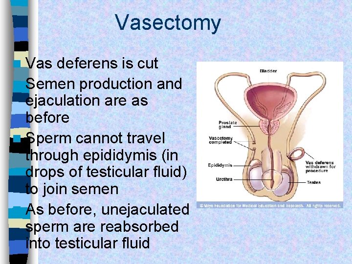 Vasectomy n Vas deferens is cut n Semen production and ejaculation are as before