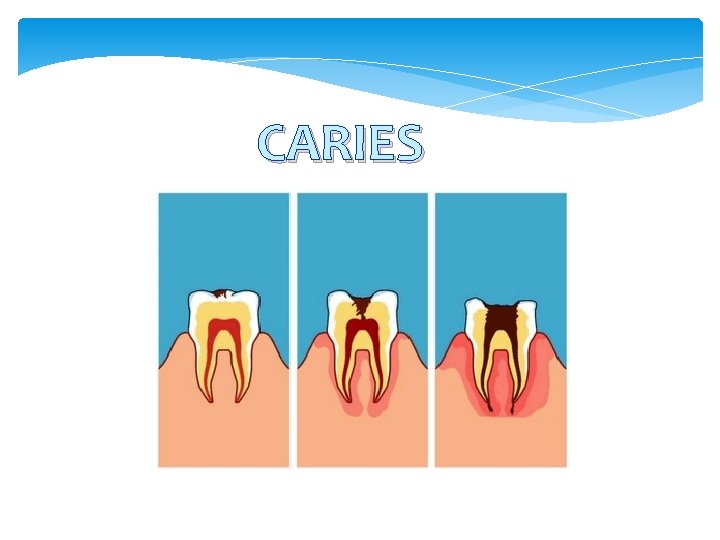 CARIES 