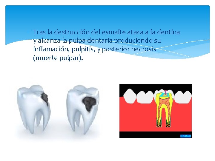  Tras la destrucción del esmalte ataca a la dentina y alcanza la pulpa