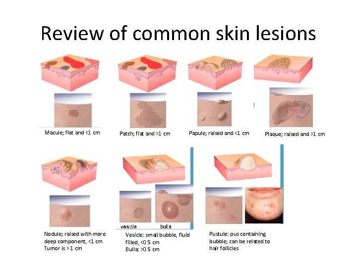 Review of common skin lesions Macule; flat and <1 cm Nodule; raised with more
