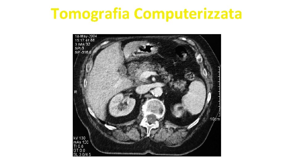 Tomografia Computerizzata 