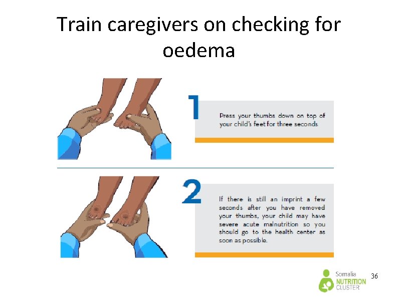 Train caregivers on checking for oedema 36 Train caregivers on checking for oedema 36