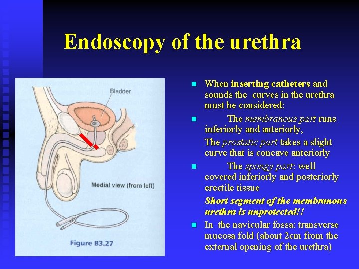 Endoscopy of the urethra n n When inserting catheters and sounds the curves in