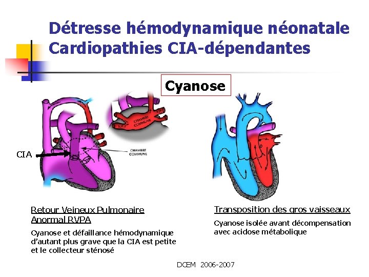 Détresse hémodynamique néonatale Cardiopathies CIA-dépendantes Cyanose CIA Retour Veineux Pulmonaire Anormal RVPA Cyanose et