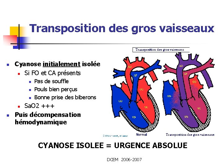 Transposition des gros vaisseaux n Cyanose initialement isolée n Si FO et CA présents