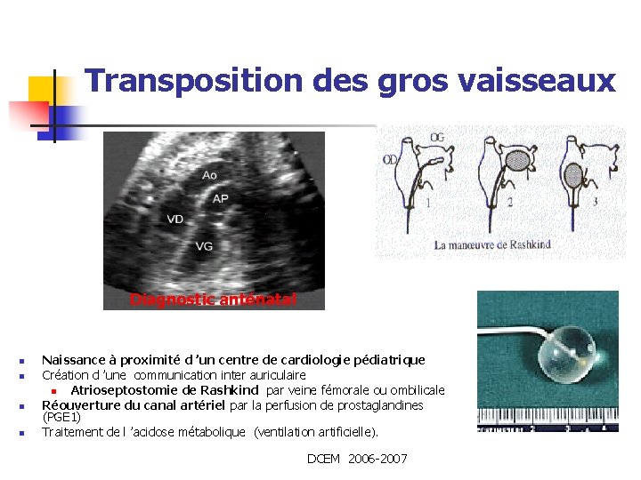 Transposition des gros vaisseaux Diagnostic anténatal n n Naissance à proximité d ’un centre