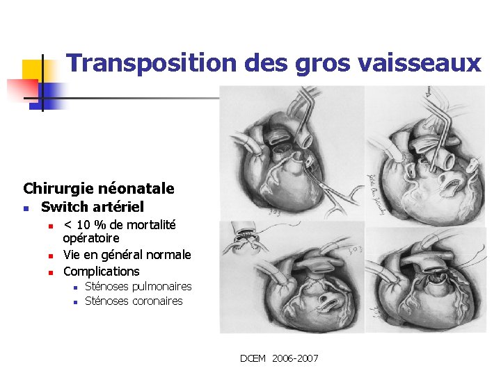 Transposition des gros vaisseaux Chirurgie néonatale n Switch artériel n n n < 10