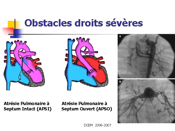 Obstacles droits sévères Atrésie Pulmonaire à Septum Intact (APSI) Atrésie Pulmonaire à Septum Ouvert