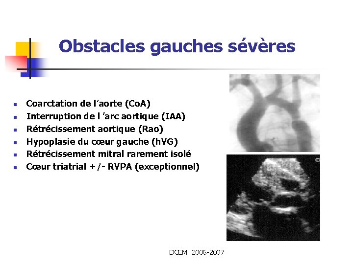 Obstacles gauches sévères n n n Coarctation de l’aorte (Co. A) Interruption de l