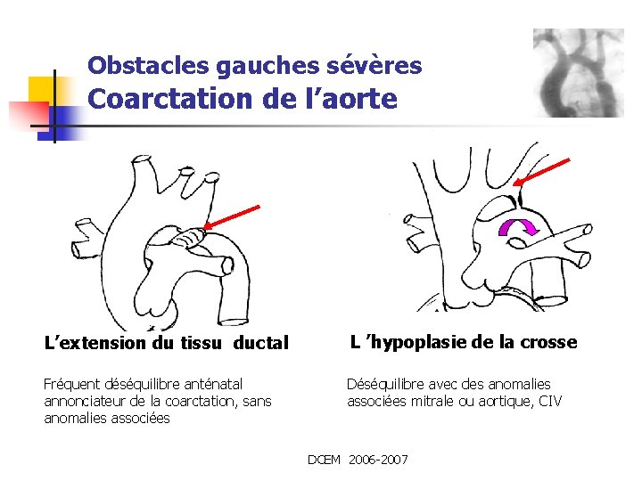 Obstacles gauches sévères Coarctation de l’aorte L’extension du tissu ductal L ’hypoplasie de la