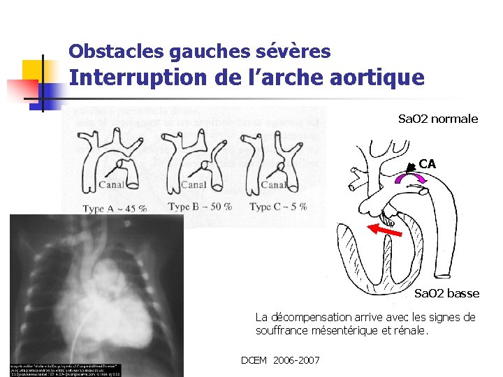 Obstacles gauches sévères Interruption de l’arche aortique Sa. O 2 normale CA Sa. O