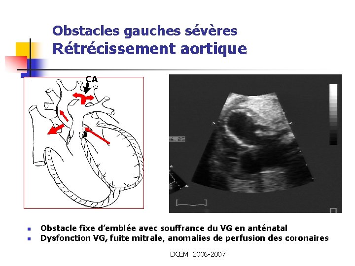 Obstacles gauches sévères Rétrécissement aortique CA n n Obstacle fixe d’emblée avec souffrance du