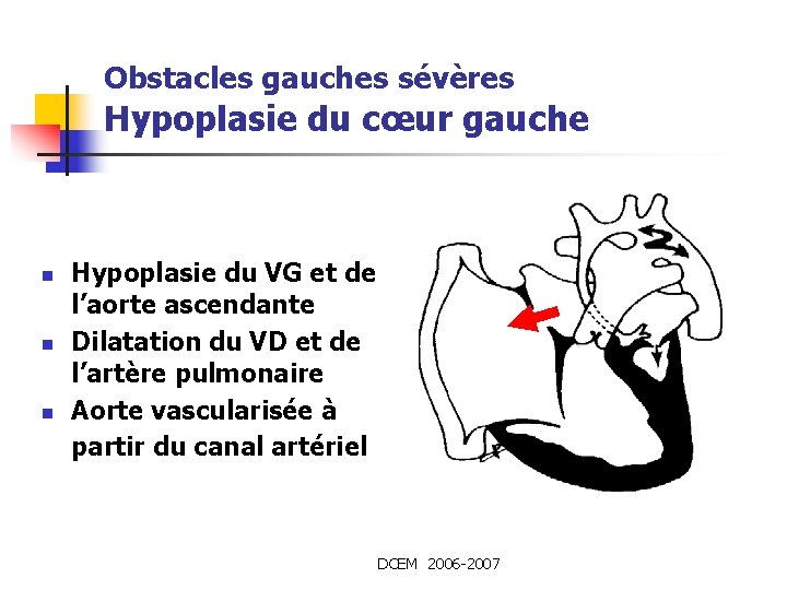 Obstacles gauches sévères Hypoplasie du cœur gauche n n n Hypoplasie du VG et